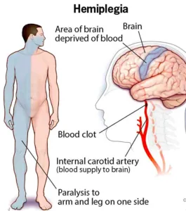 Hemiplegjia e njeriut